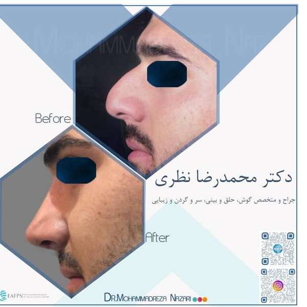 عکس عمل بینی 