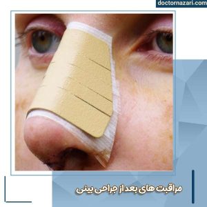 مراقبت های بعد از عمل بینی