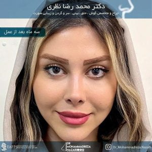 نمونه کار بهترین جراح بینی تبریز - doctornazari.com