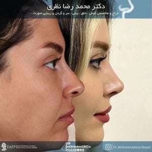 نمونه کار بهترین جراح بینی تبریز - doctornazari.com