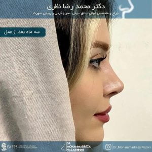 نمونه کار بهترین جراح بینی تبریز - doctornazari.com
