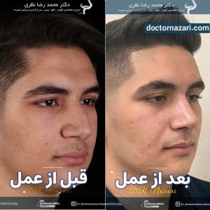 عکس قبل و بعد عمل بینی طبیعی مردانه
