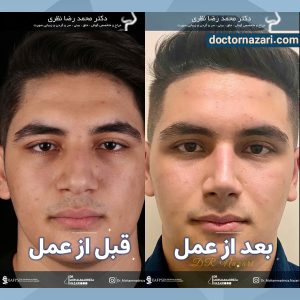 عکس قبل و بعد عمل بینی طبیعی مردانه