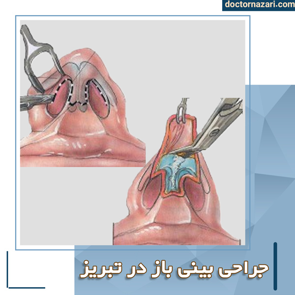 عمل بینی باز در تبریز + دکتر محمدرضا نظری
