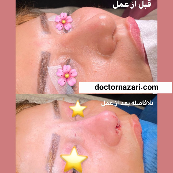 عکس قبل و بعد ترمیم بینی