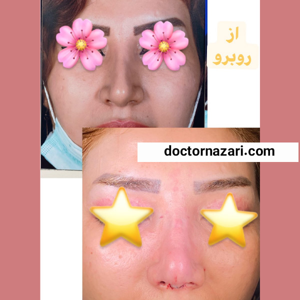 عکس قبل و بعد ترمیم بینی
