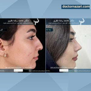 عکس قبل و بعد عمل بینی در تبریز
