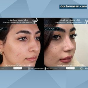 عکس قبل و بعد عمل بینی در تبریز