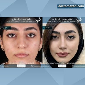 عکس قبل و بعد عمل بینی در تبریز