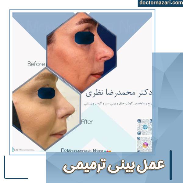 عکس عمل ترمیم بینی