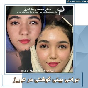عمل بینی گوشتی در تبریز + دکتر محمدرضا نظری