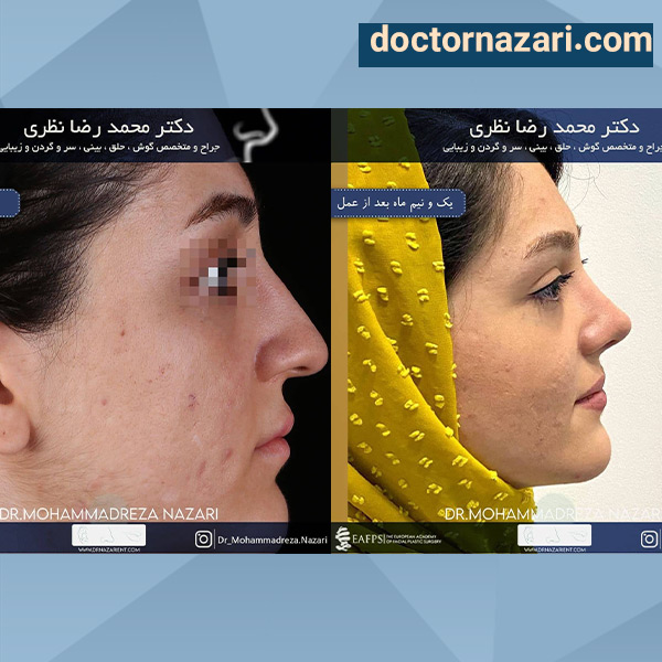 عکس عمل بینی گوشتی و پهن