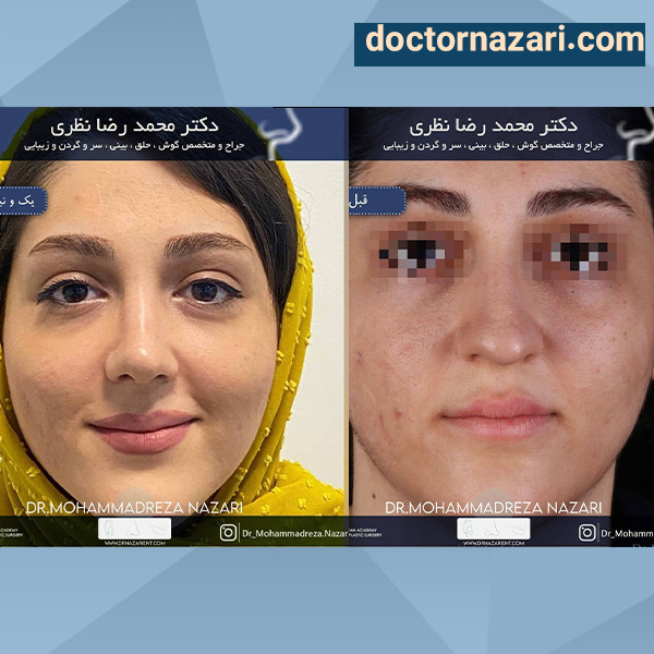عکس عمل بینی گوشتی و پهن