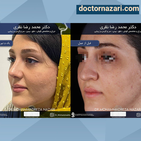 عکس عمل بینی گوشتی و پهن