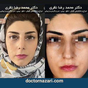 قبل و بعد از عمل بینی استخوانی در تبریز