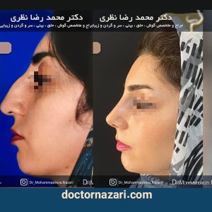 قبل و بعد از عمل بینی استخوانی در تبریز