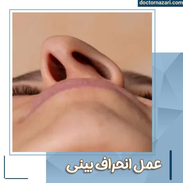 عمل انحراف بینی