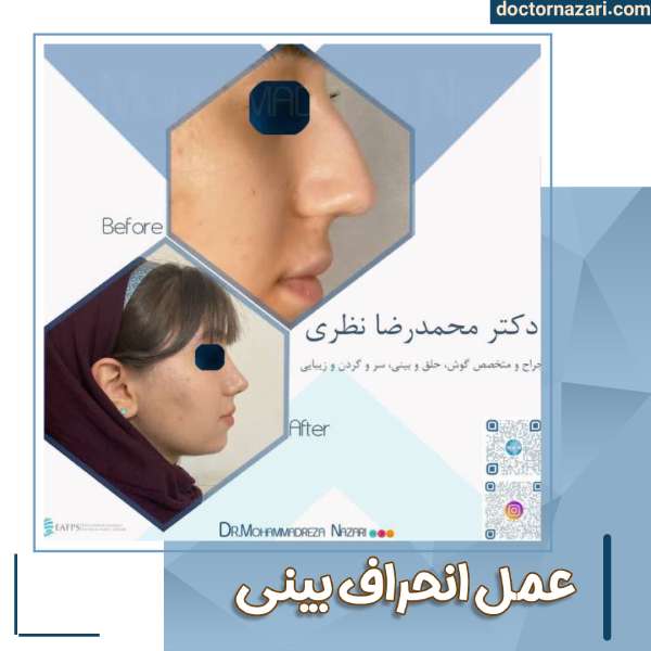 عمل انحراف بینی