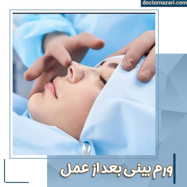 تورم بینی