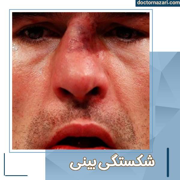 جراحی بینی شکسته