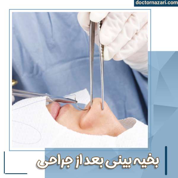 بخیه نوک بینی بعد از عمل