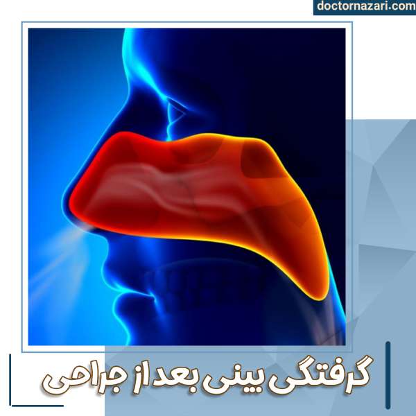 گرفتگی بینی بعد از جراحی