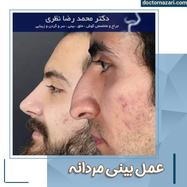 عمل بینی مردانه