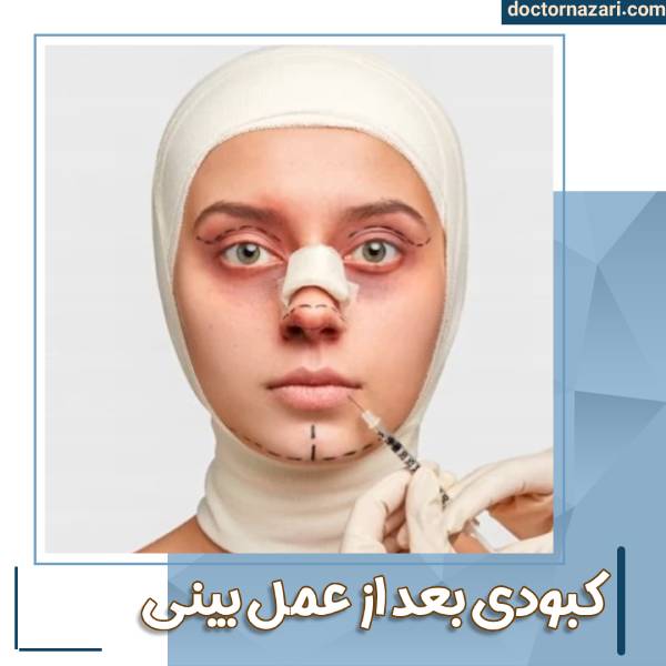 کبودی بعد از عمل بینی