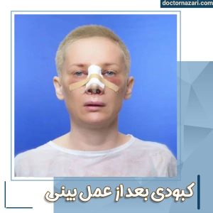 کبودی بعد از عمل بینی