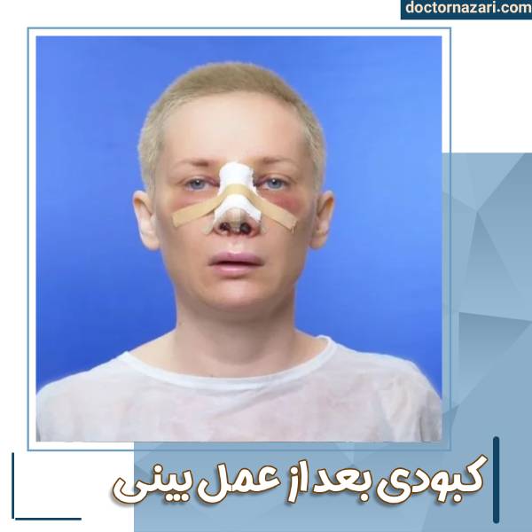 کبودی بعد از عمل بینی