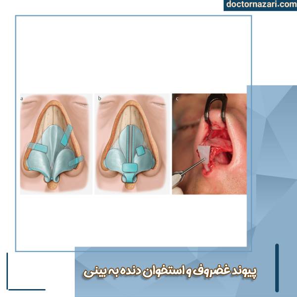 عکس پیوند استخوان دنده به بینی
