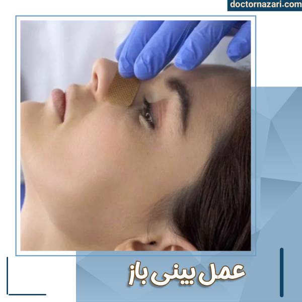 جراحی بینی باز