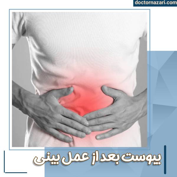 عکس یبوست بعد از عمل بینی
