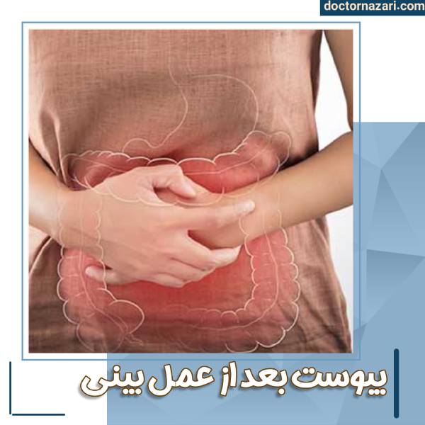 یبوست بعد از جراحی بینی