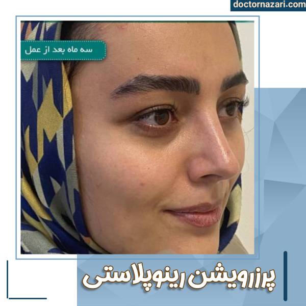 پرزرویشن رینوپلاستی در تبریز با دکتر نظری