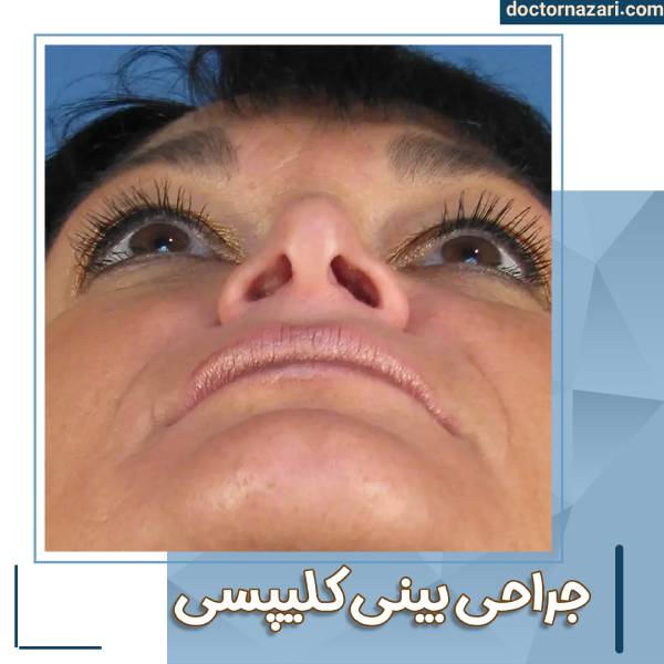 عمل بینی منگنه ای - دکتر محمدرضا نظری