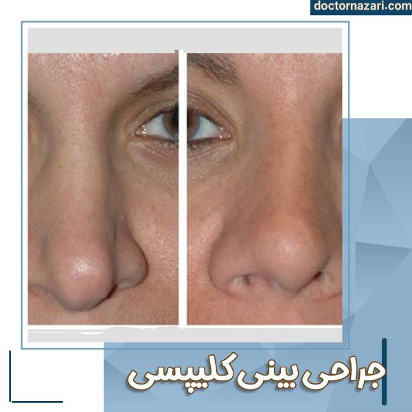 جراحی بینی کلیپسی