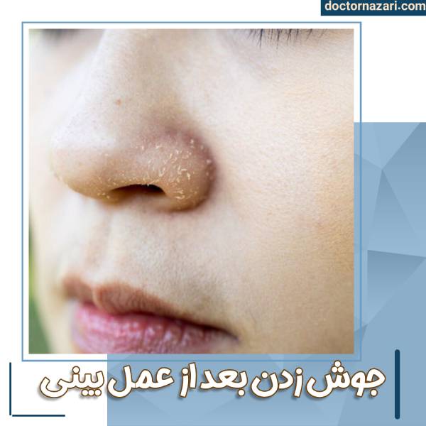 جوش سرسیاه بعد از جراحی بینی