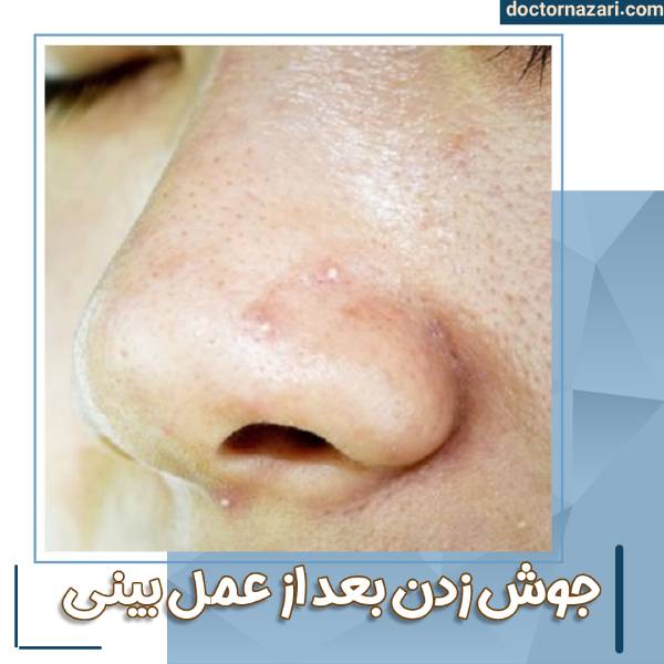جوش زدن بعد از عمل بینی