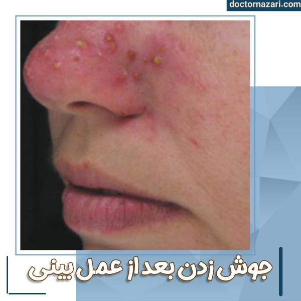 جوش زدن بعد از عمل بینی