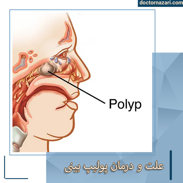 پولیپ بینی - دکتر محمدرضا نظری