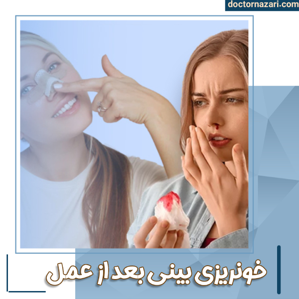 علت خونریزی بینی بعد از عمل با دکتر محمدرضا نظری