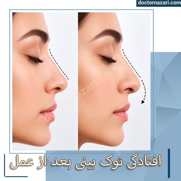 افتادگی نوک بینی بعد از عمل با دکتر محمدرضا نظری