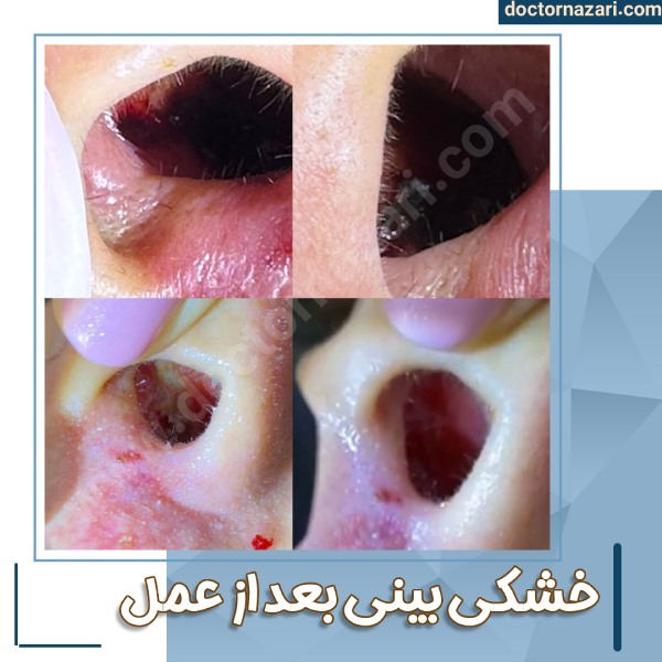 خشکی بینی بعد از عمل با دکتر نظری در تبریز